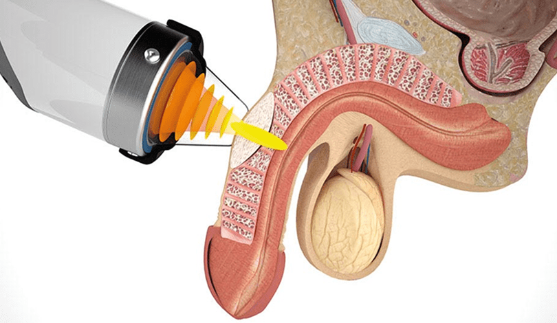 Peyronie’s Disease