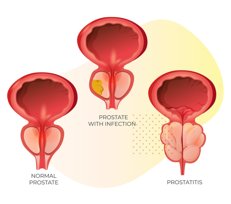 Prostatitis