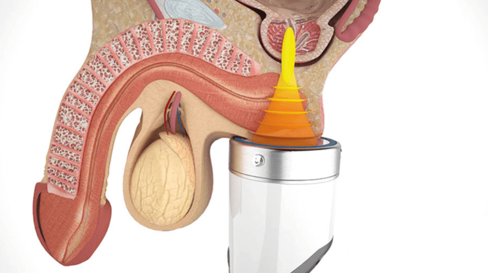 Treatment illustration